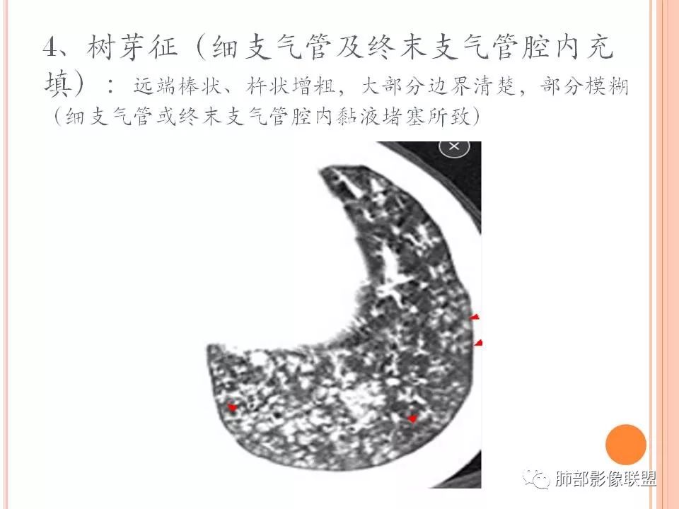 【PPT】支原体肺炎影像分析 【PPT】支原体肺炎影像分析
