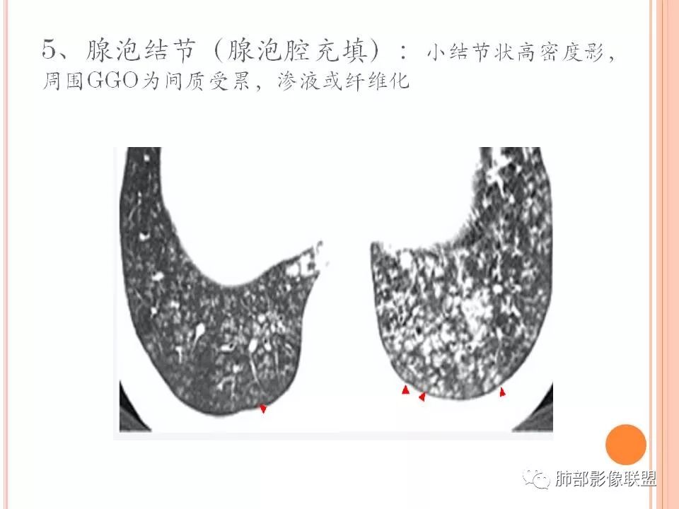 【PPT】支原体肺炎影像分析 【PPT】支原体肺炎影像分析