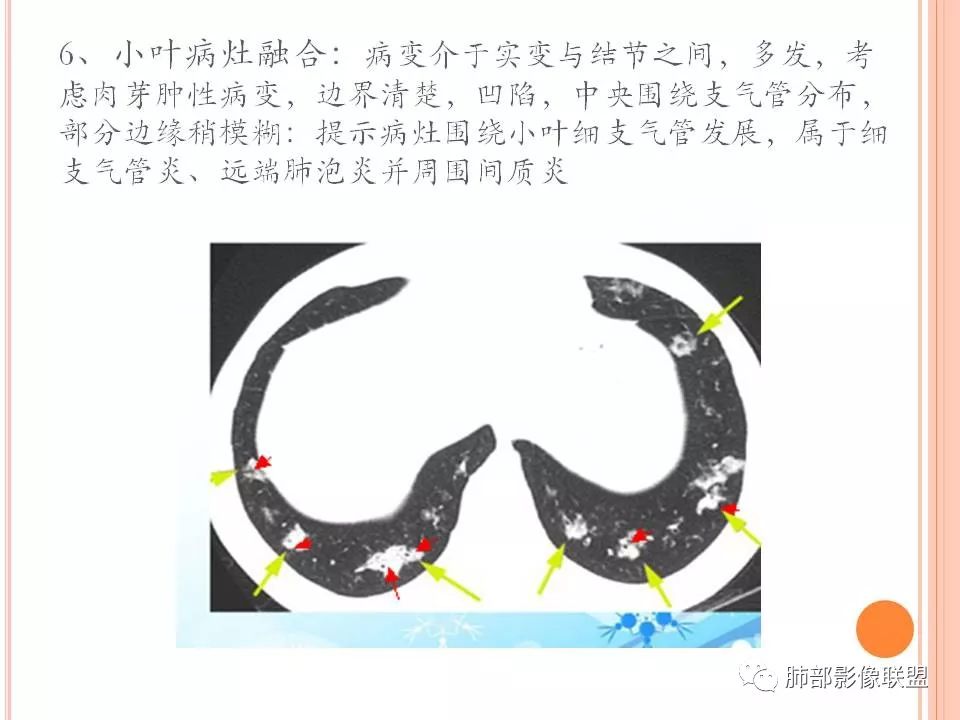 【PPT】支原体肺炎影像分析 【PPT】支原体肺炎影像分析