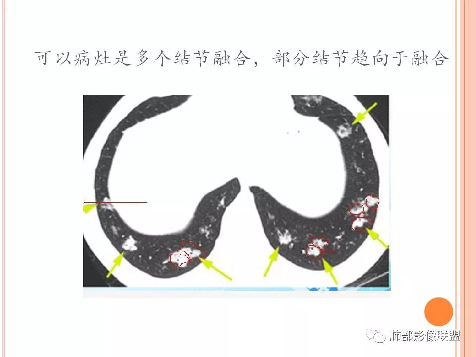【PPT】支原体肺炎影像分析 【PPT】支原体肺炎影像分析