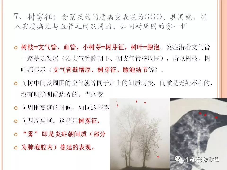 【PPT】支原体肺炎影像分析 【PPT】支原体肺炎影像分析