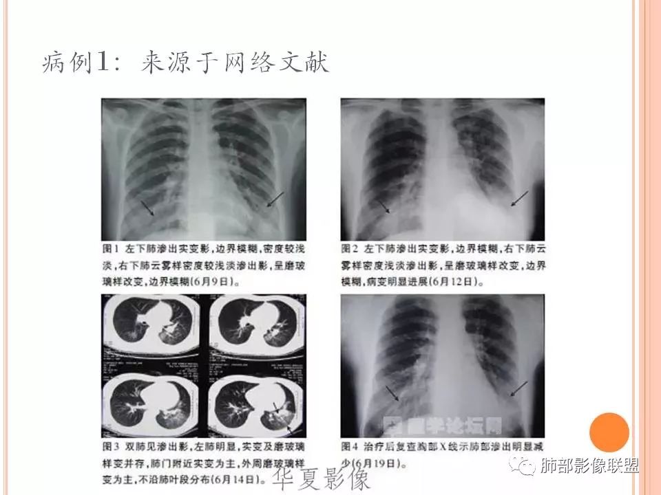 【PPT】支原体肺炎影像分析 【PPT】支原体肺炎影像分析