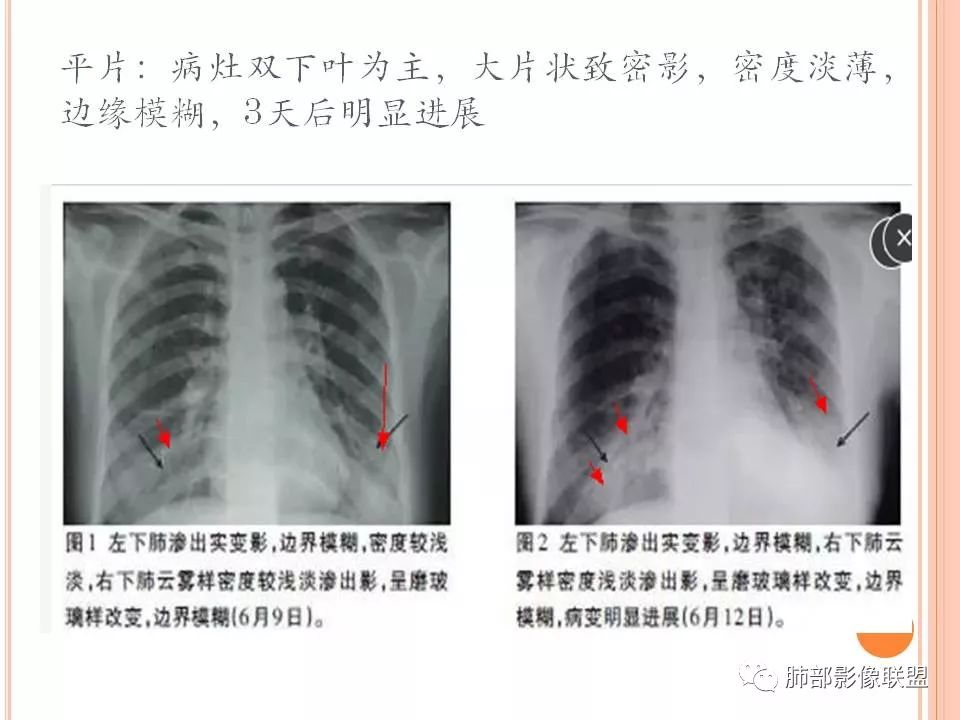 【PPT】支原体肺炎影像分析 【PPT】支原体肺炎影像分析