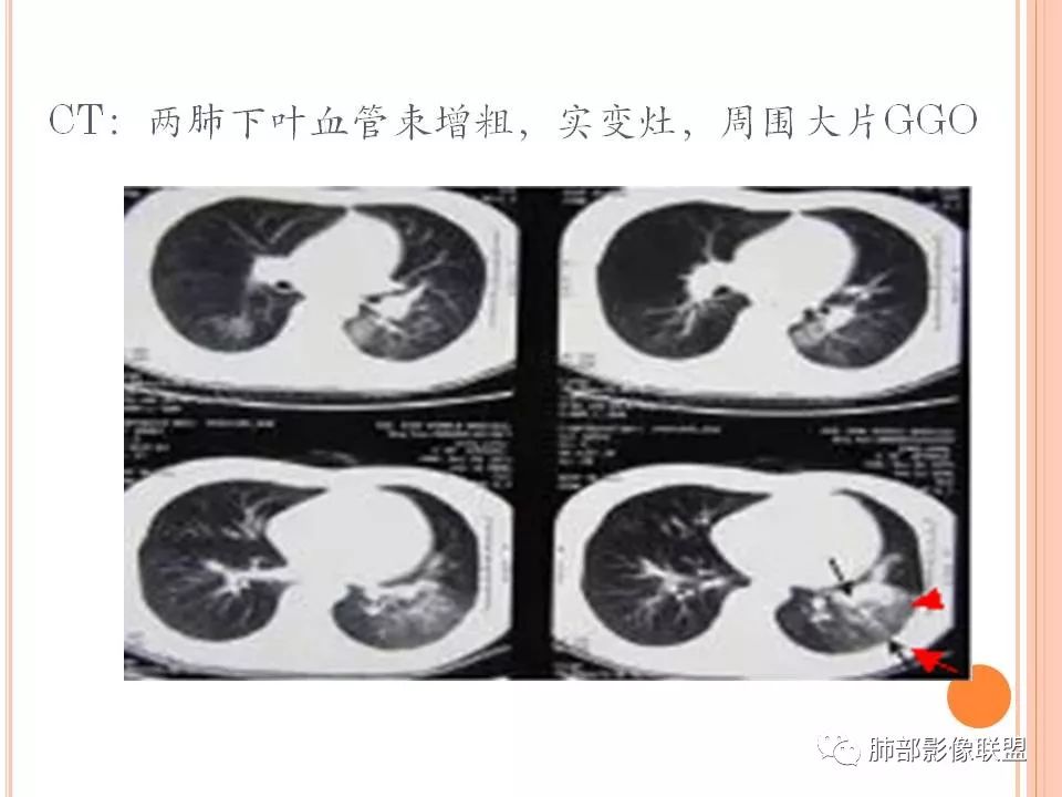【PPT】支原体肺炎影像分析 【PPT】支原体肺炎影像分析