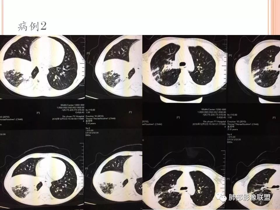 【PPT】支原体肺炎影像分析 【PPT】支原体肺炎影像分析