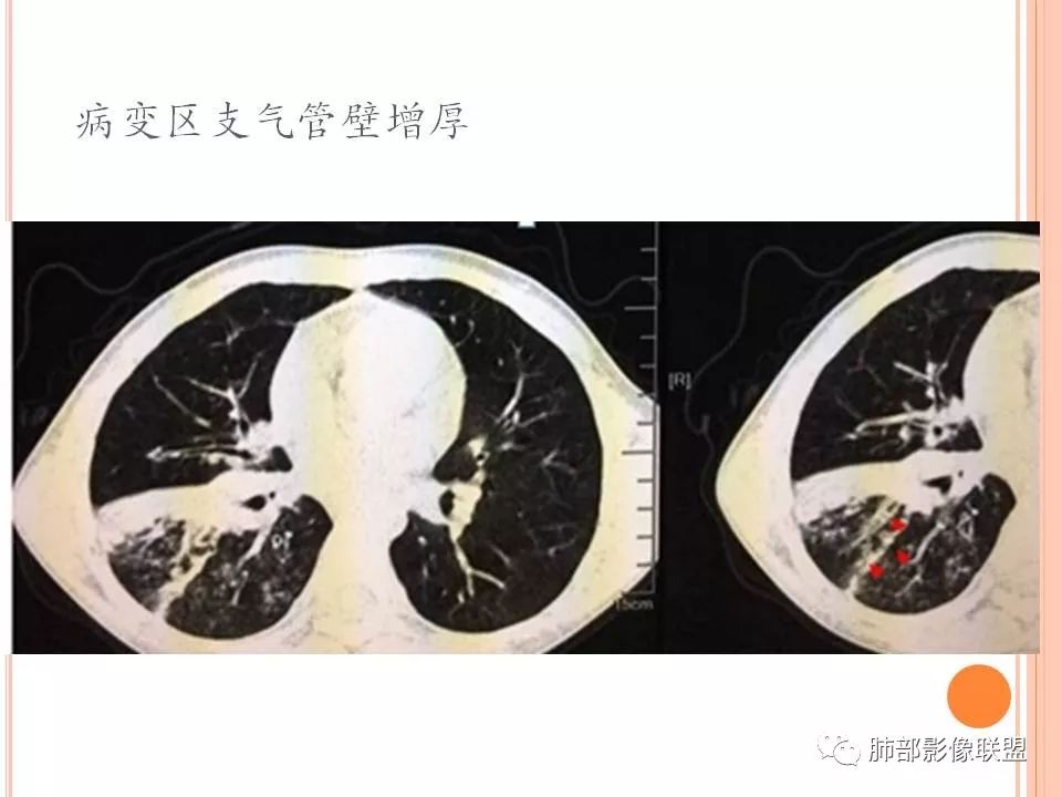 【PPT】支原体肺炎影像分析 【PPT】支原体肺炎影像分析