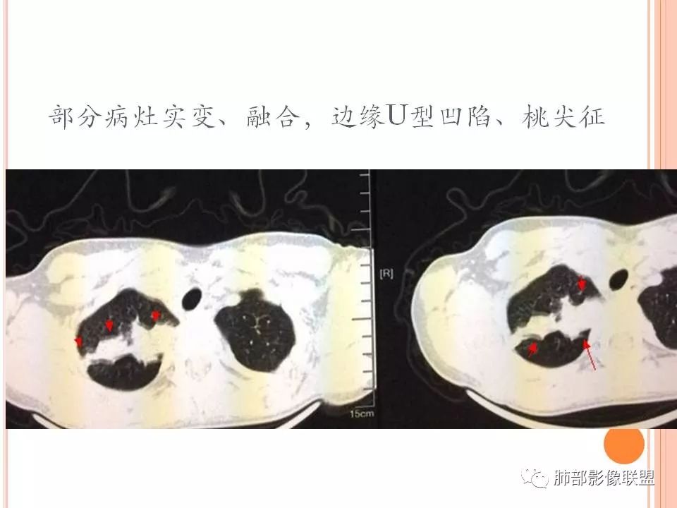 【PPT】支原体肺炎影像分析 【PPT】支原体肺炎影像分析