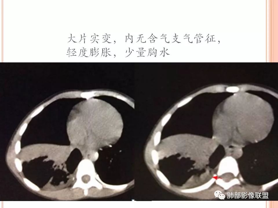 【PPT】支原体肺炎影像分析 【PPT】支原体肺炎影像分析