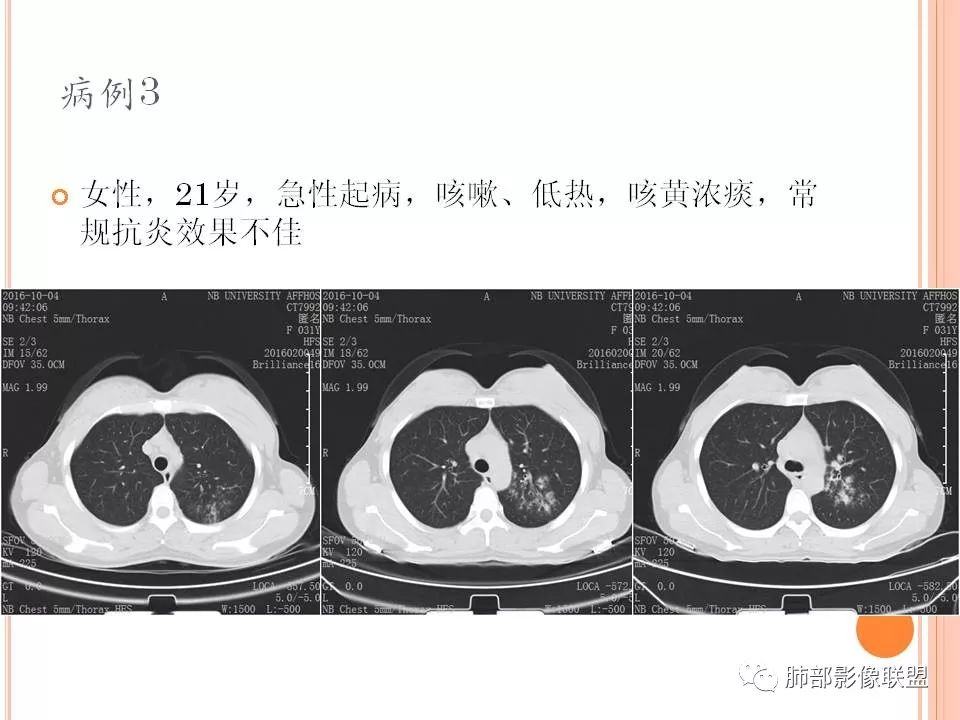 【PPT】支原体肺炎影像分析 【PPT】支原体肺炎影像分析