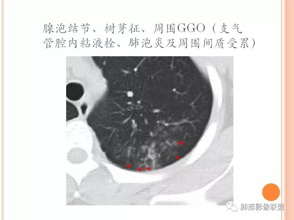 【PPT】支原体肺炎影像分析 【PPT】支原体肺炎影像分析