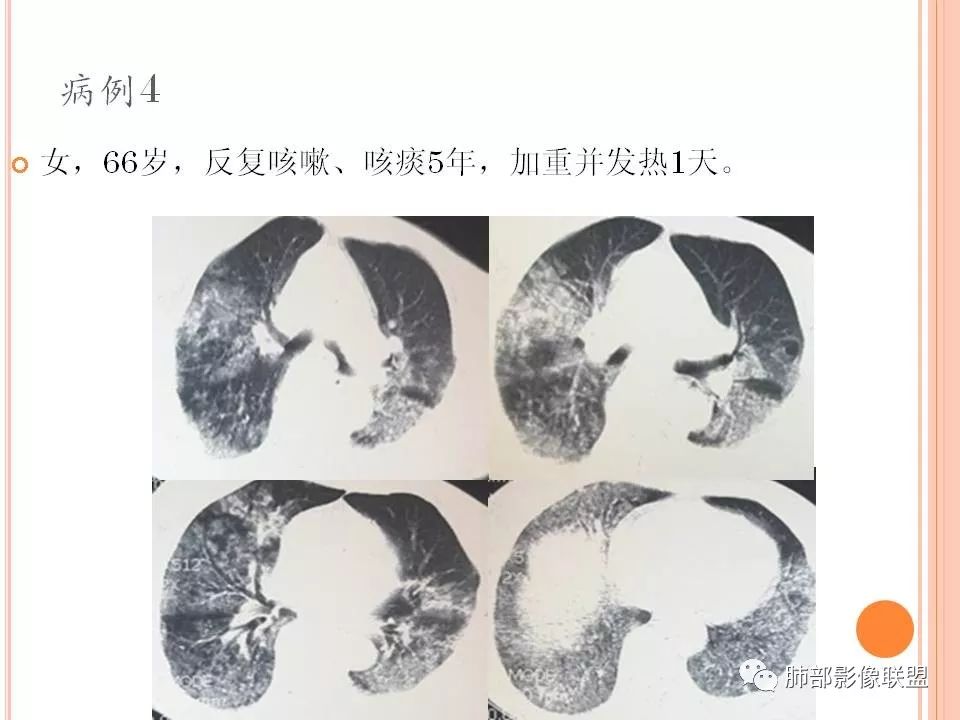 【PPT】支原体肺炎影像分析 【PPT】支原体肺炎影像分析