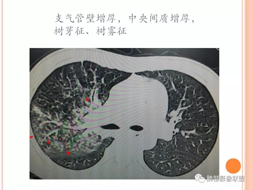 【PPT】支原体肺炎影像分析 【PPT】支原体肺炎影像分析