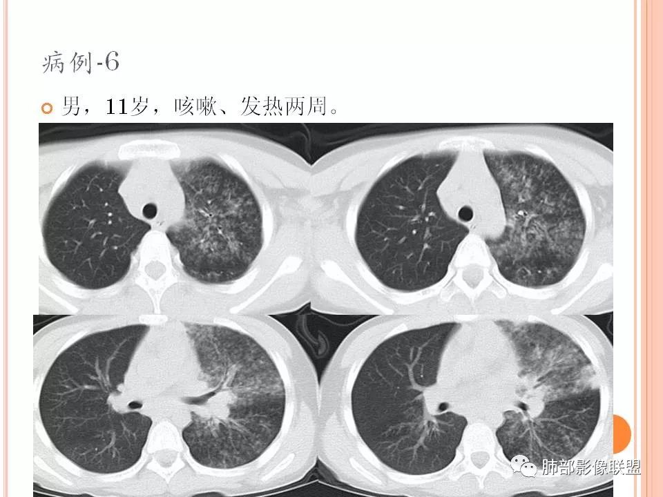【PPT】支原体肺炎影像分析 【PPT】支原体肺炎影像分析