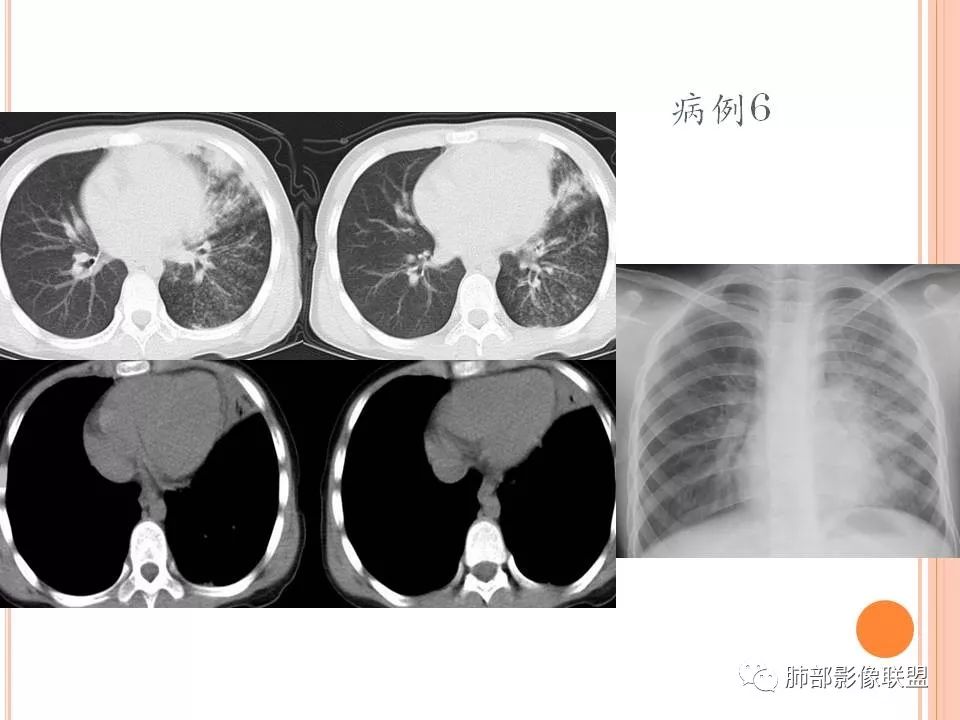 【PPT】支原体肺炎影像分析 【PPT】支原体肺炎影像分析
