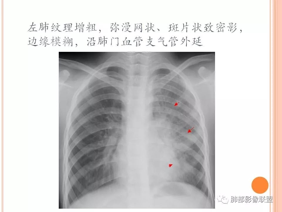 【PPT】支原体肺炎影像分析 【PPT】支原体肺炎影像分析