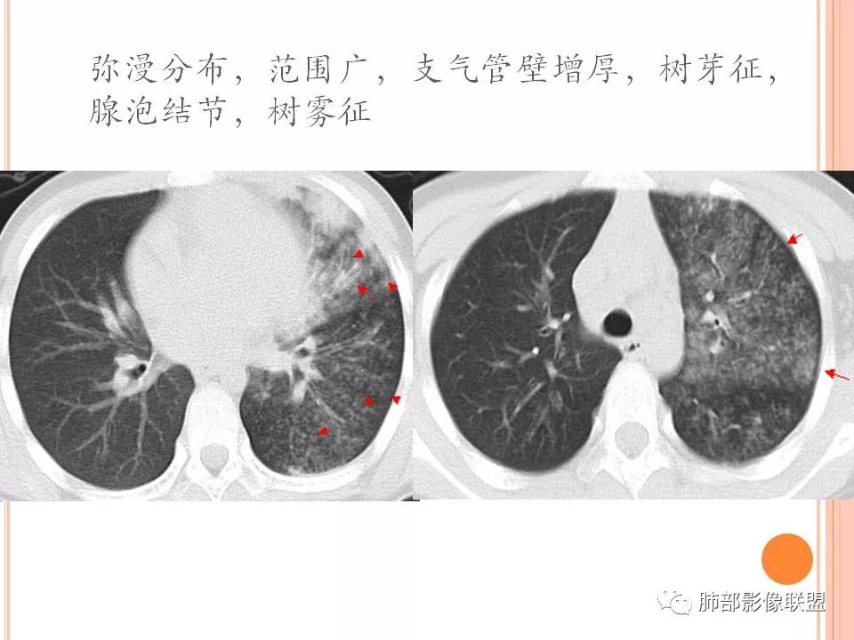【PPT】支原体肺炎影像分析 【PPT】支原体肺炎影像分析