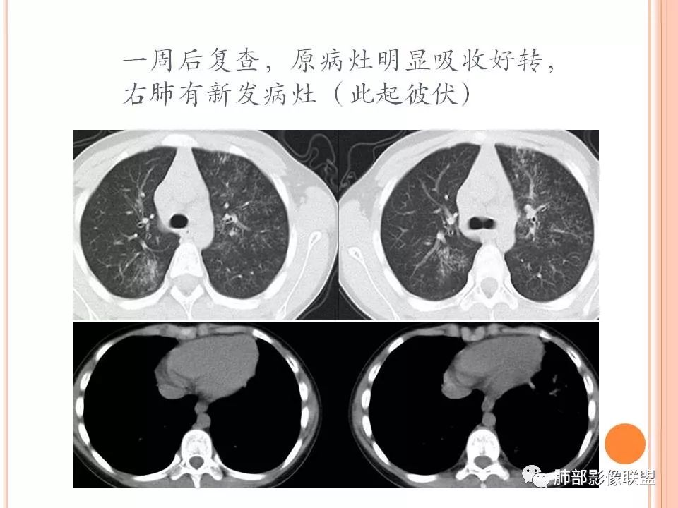 【PPT】支原体肺炎影像分析 【PPT】支原体肺炎影像分析