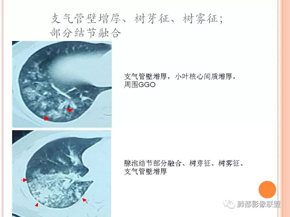 【PPT】支原体肺炎影像分析 【PPT】支原体肺炎影像分析