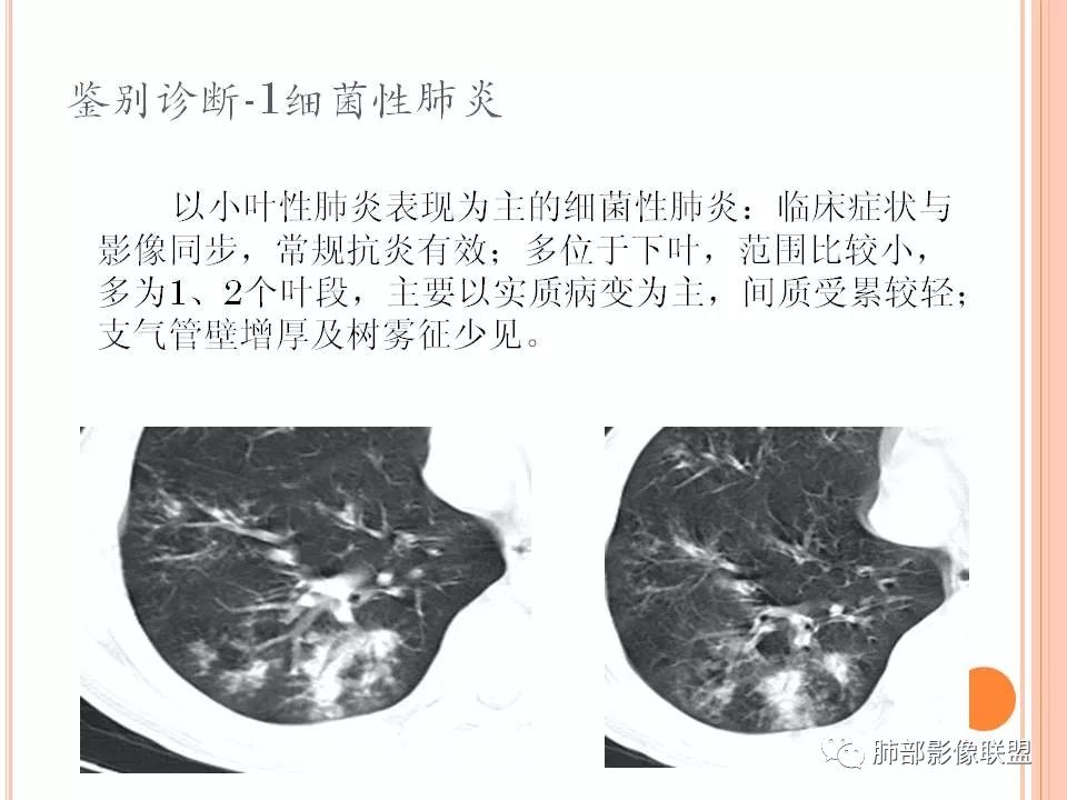 【PPT】支原体肺炎影像分析 【PPT】支原体肺炎影像分析