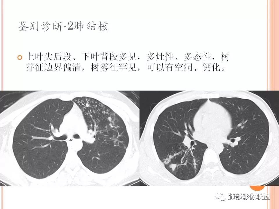 【PPT】支原体肺炎影像分析 【PPT】支原体肺炎影像分析