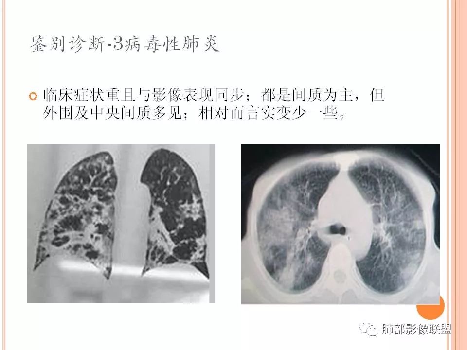 【PPT】支原体肺炎影像分析 【PPT】支原体肺炎影像分析