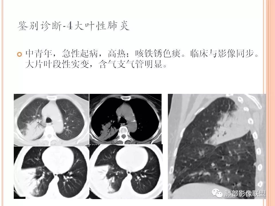 【PPT】支原体肺炎影像分析 【PPT】支原体肺炎影像分析