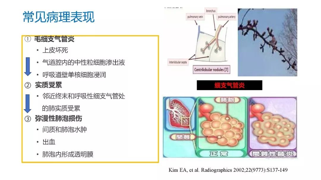 【PPT】以史为鉴，以影为鉴--COVID-19CT诊断、鉴别诊断与思考