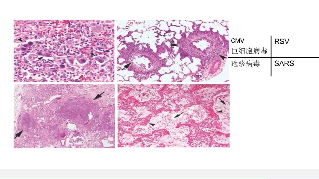 【PPT】以史为鉴，以影为鉴--COVID-19CT诊断、鉴别诊断与思考