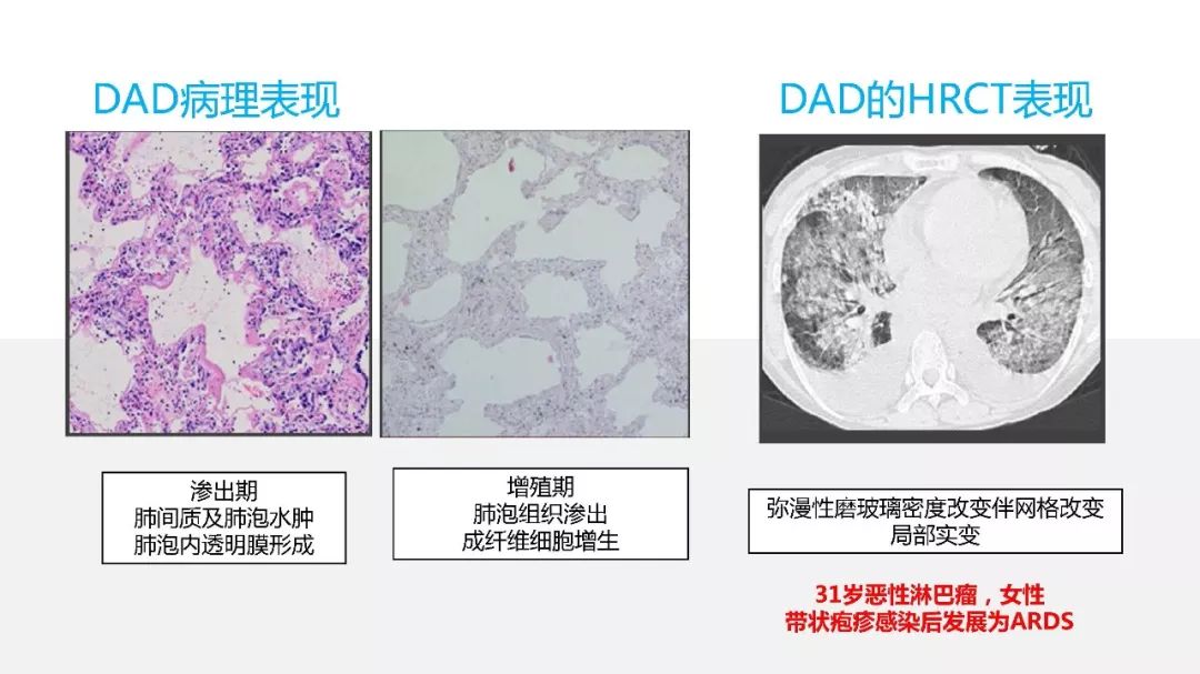 【PPT】以史为鉴，以影为鉴--COVID-19CT诊断、鉴别诊断与思考