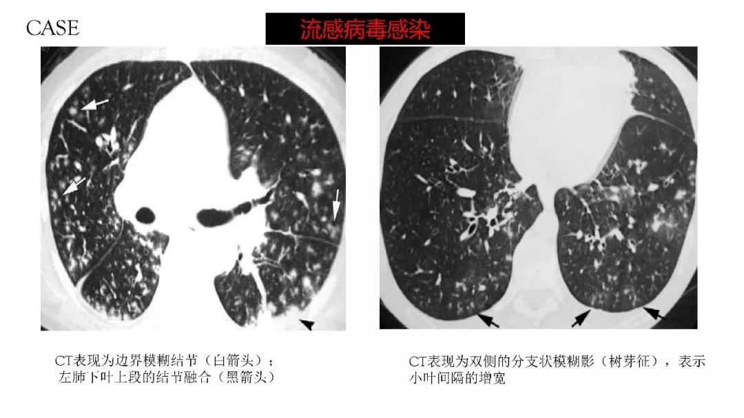 【PPT】以史为鉴，以影为鉴--COVID-19CT诊断、鉴别诊断与思考
