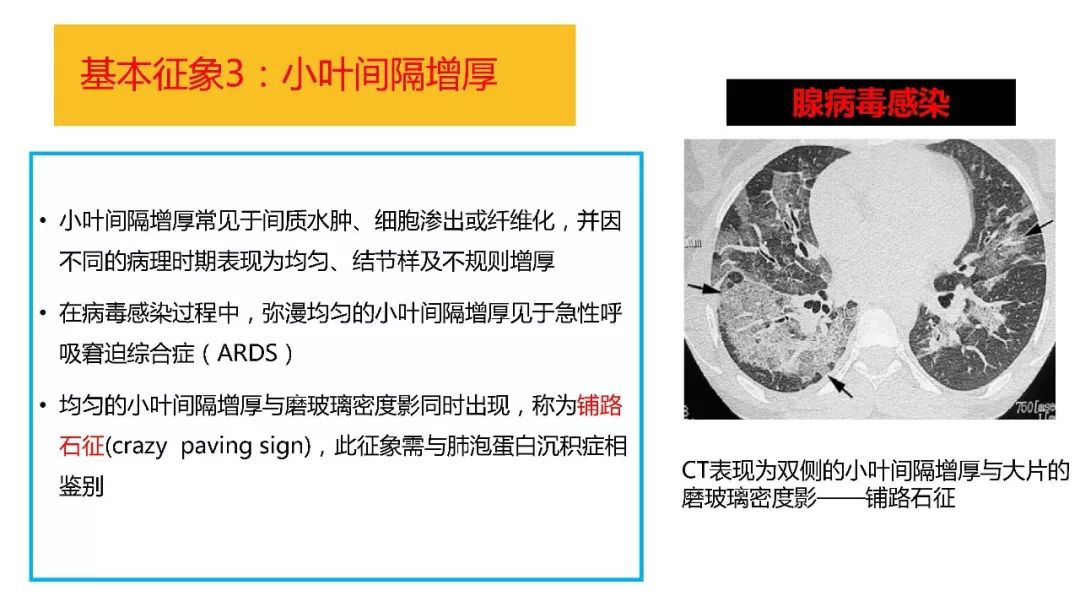 【PPT】以史为鉴，以影为鉴--COVID-19CT诊断、鉴别诊断与思考