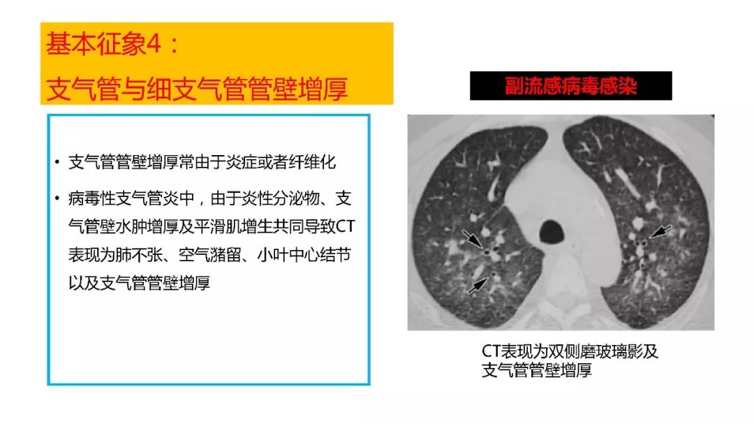 【PPT】以史为鉴，以影为鉴--COVID-19CT诊断、鉴别诊断与思考