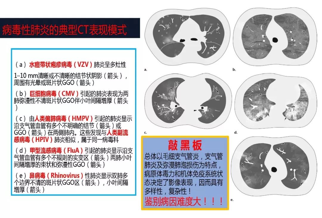 【PPT】以史为鉴，以影为鉴--COVID-19CT诊断、鉴别诊断与思考