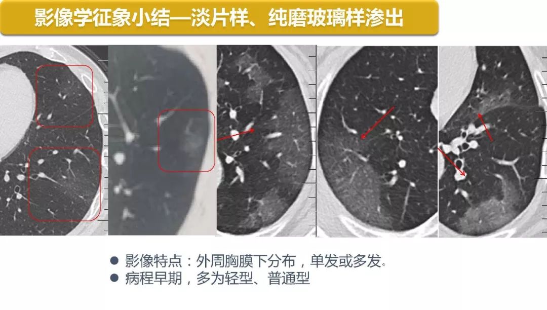 【PPT】以史为鉴，以影为鉴--COVID-19CT诊断、鉴别诊断与思考