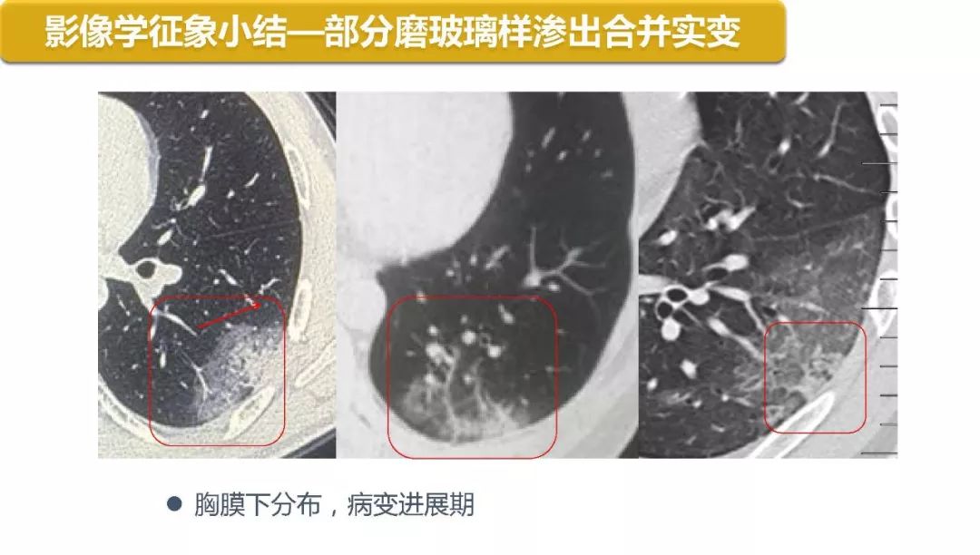 【PPT】以史为鉴，以影为鉴--COVID-19CT诊断、鉴别诊断与思考