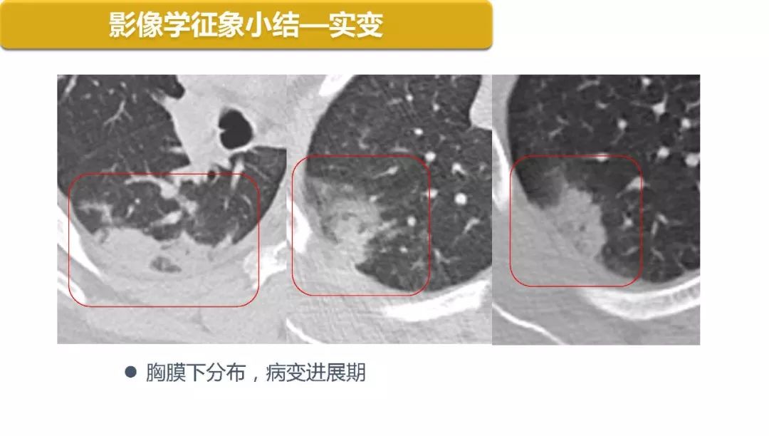 【PPT】以史为鉴，以影为鉴--COVID-19CT诊断、鉴别诊断与思考