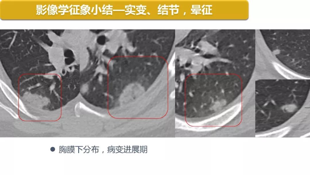 【PPT】以史为鉴，以影为鉴--COVID-19CT诊断、鉴别诊断与思考