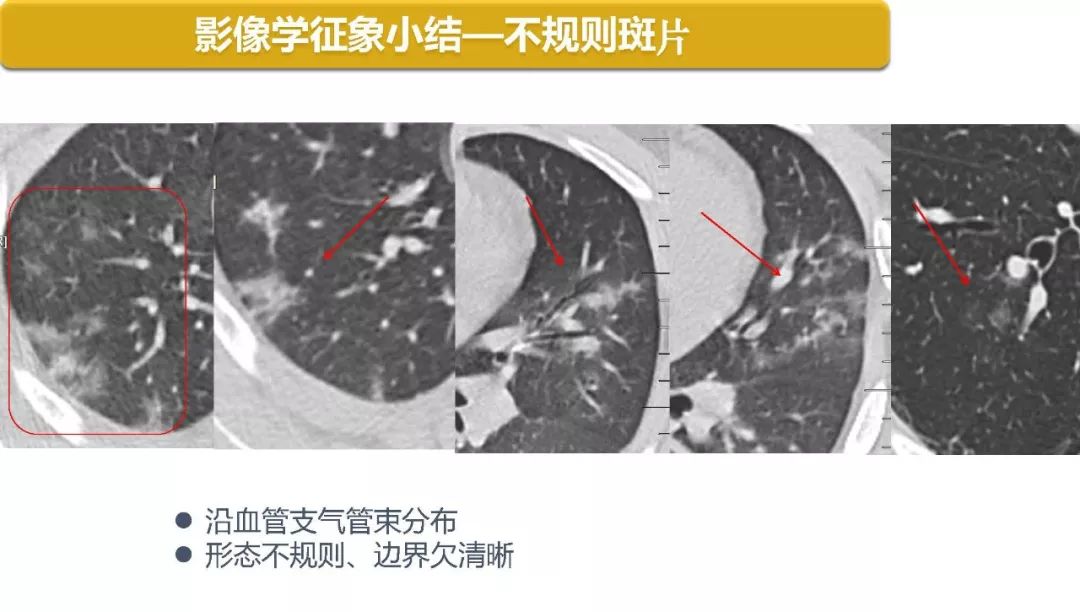 【PPT】以史为鉴，以影为鉴--COVID-19CT诊断、鉴别诊断与思考