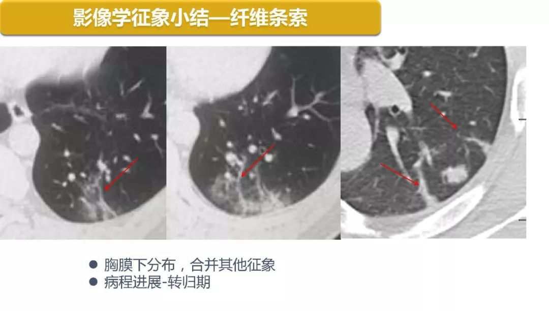 【PPT】以史为鉴，以影为鉴--COVID-19CT诊断、鉴别诊断与思考