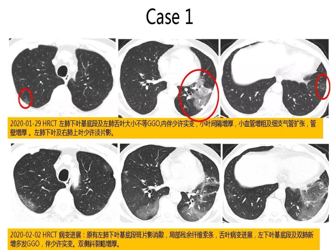【PPT】以史为鉴，以影为鉴--COVID-19CT诊断、鉴别诊断与思考