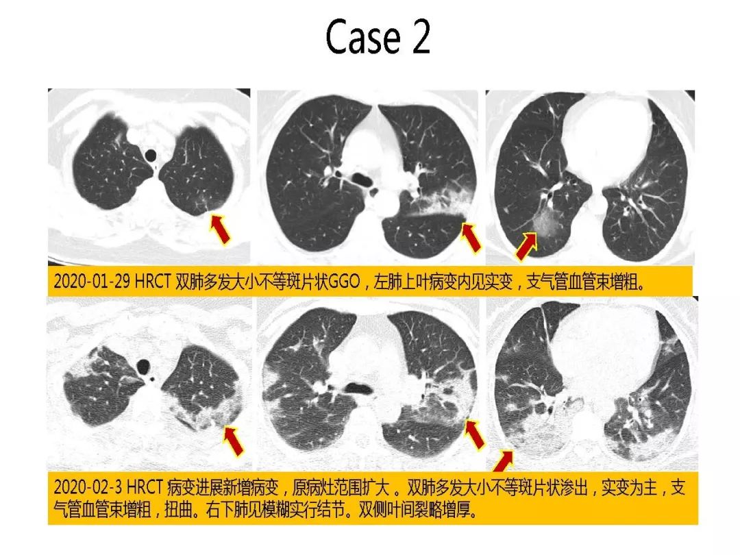 【PPT】以史为鉴，以影为鉴--COVID-19CT诊断、鉴别诊断与思考
