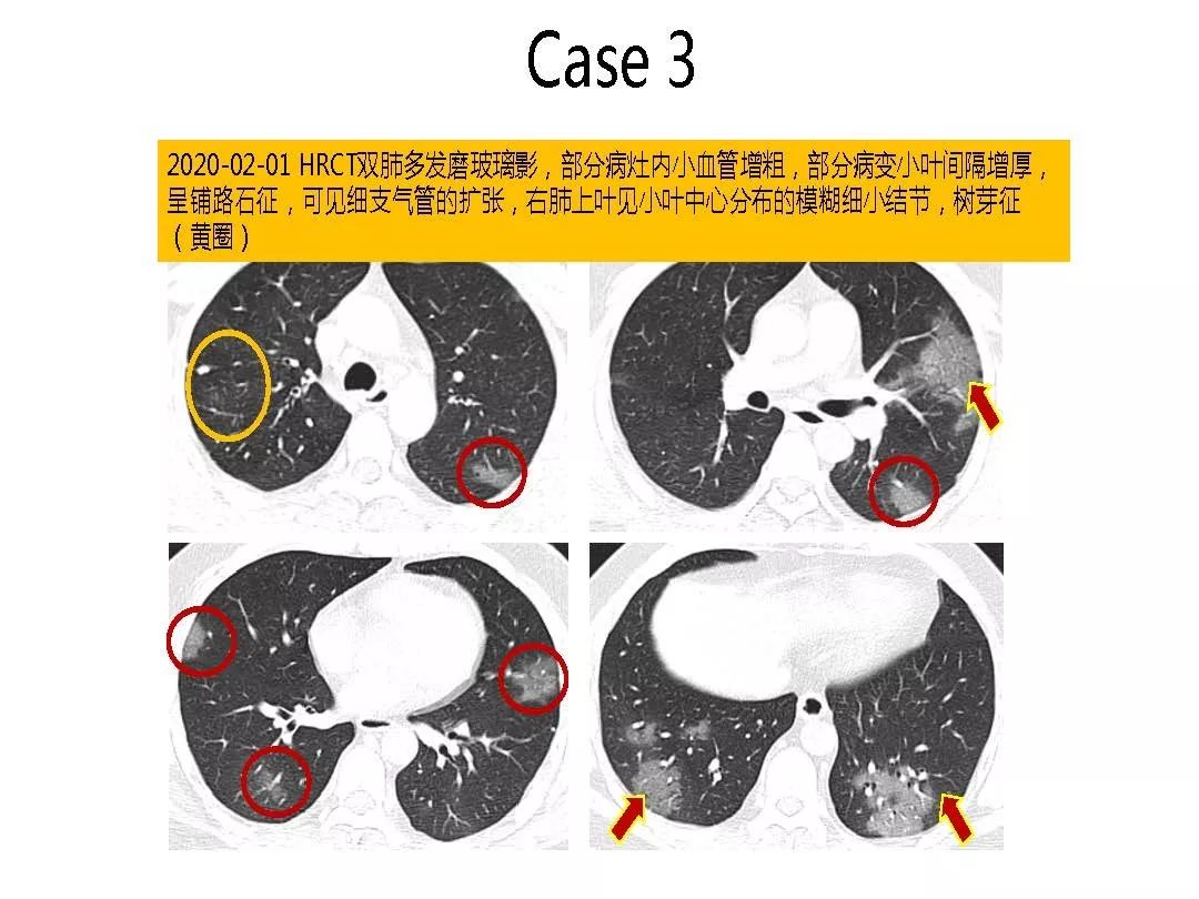 【PPT】以史为鉴，以影为鉴--COVID-19CT诊断、鉴别诊断与思考