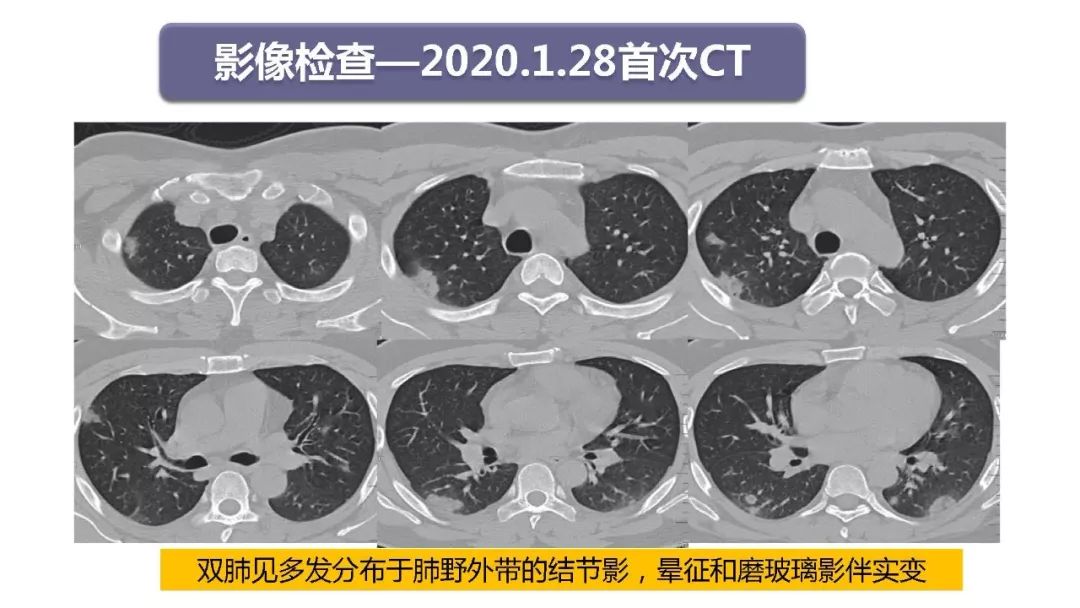 【PPT】以史为鉴，以影为鉴--COVID-19CT诊断、鉴别诊断与思考