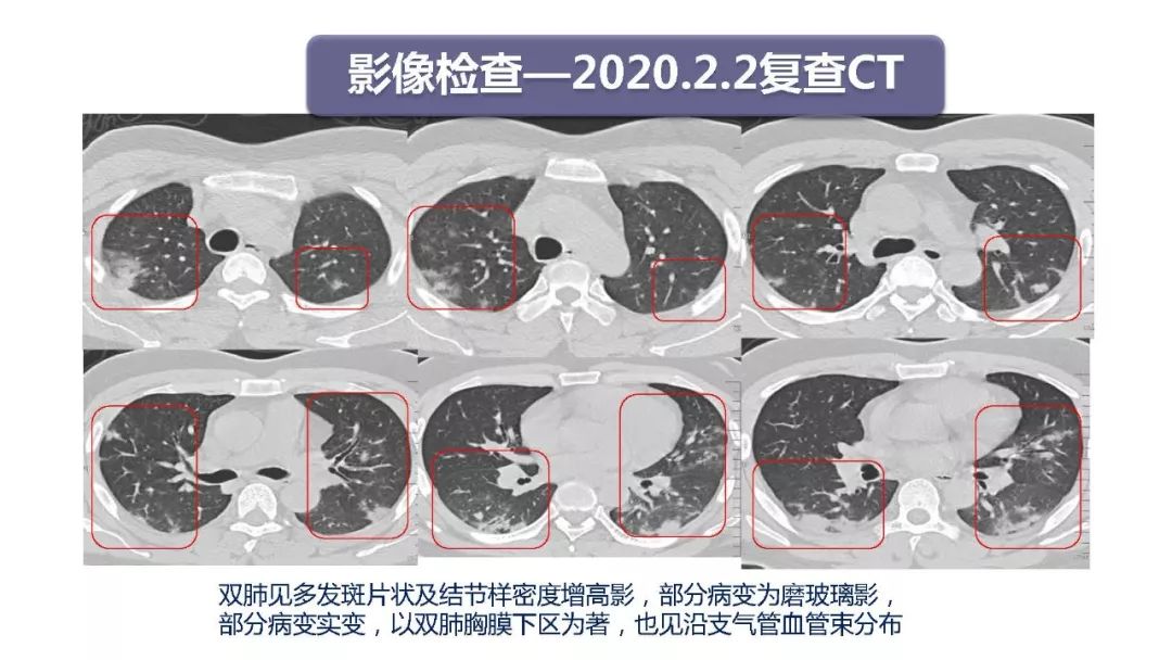 【PPT】以史为鉴，以影为鉴--COVID-19CT诊断、鉴别诊断与思考