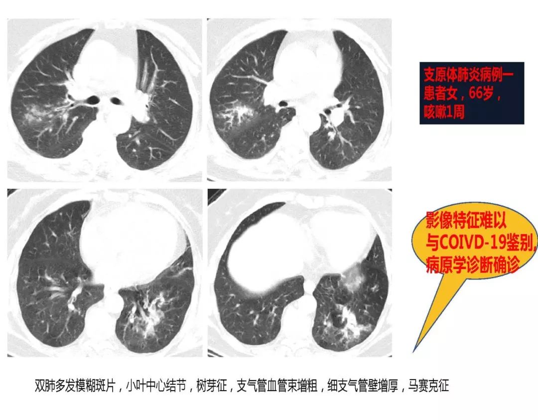 【PPT】以史为鉴，以影为鉴--COVID-19CT诊断、鉴别诊断与思考