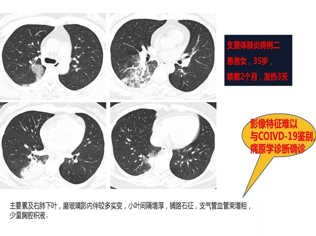 【PPT】以史为鉴，以影为鉴--COVID-19CT诊断、鉴别诊断与思考