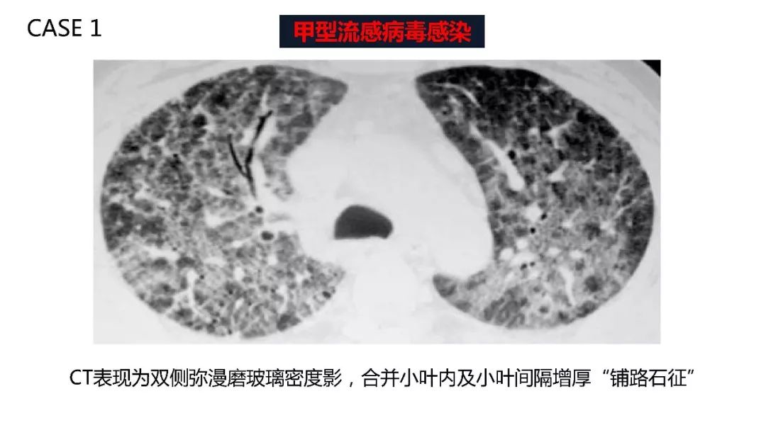 【PPT】以史为鉴，以影为鉴--COVID-19CT诊断、鉴别诊断与思考