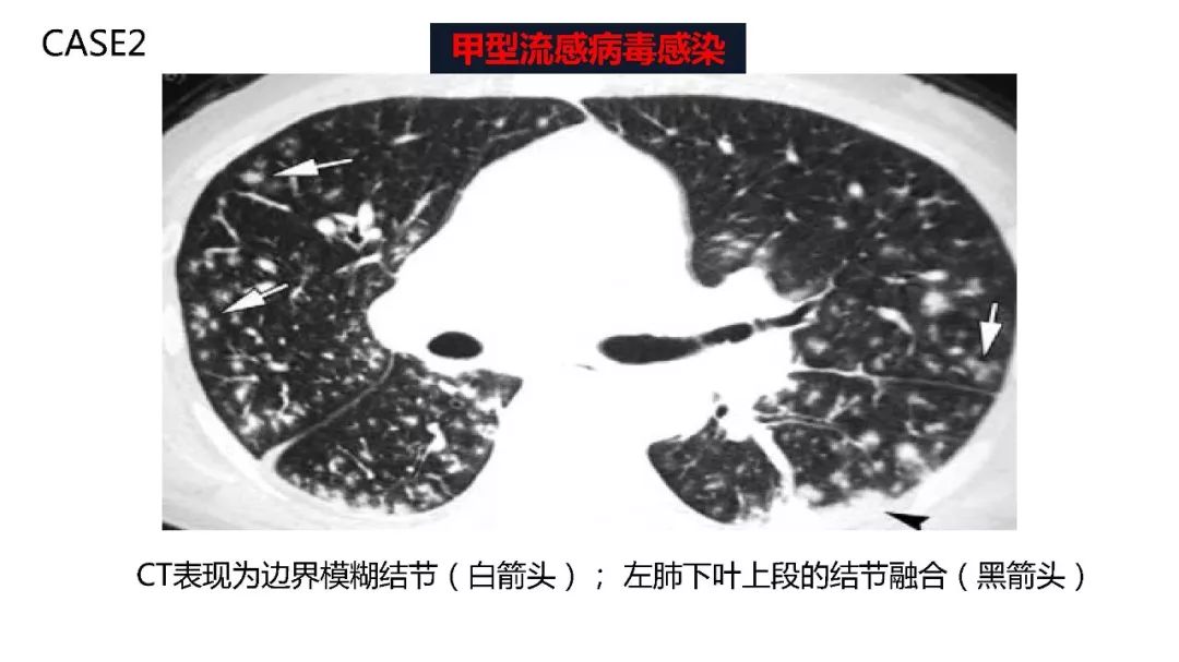 【PPT】以史为鉴，以影为鉴--COVID-19CT诊断、鉴别诊断与思考