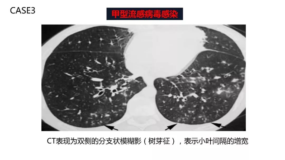 【PPT】以史为鉴，以影为鉴--COVID-19CT诊断、鉴别诊断与思考