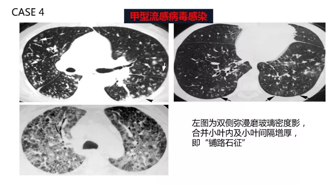 【PPT】以史为鉴，以影为鉴--COVID-19CT诊断、鉴别诊断与思考